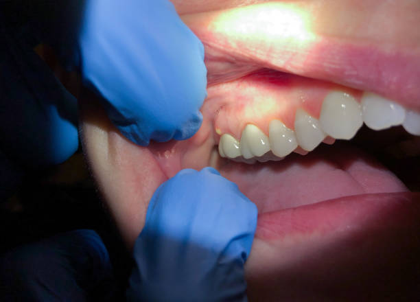 Best Emergency Dentist for Knocked-Out Tooth in Cordova, NC